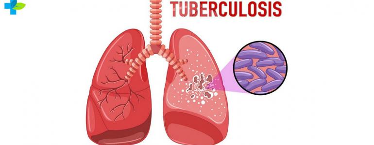 Туберкулез: симптомы, лечение, профилактика